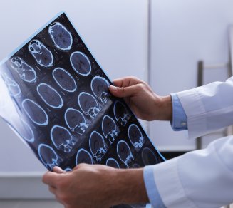 sclérose en plaques