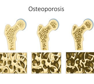 Ostéoporose