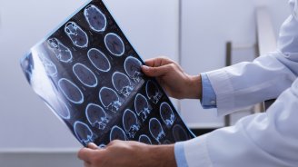 sclérose en plaques