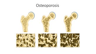Ostéoporose